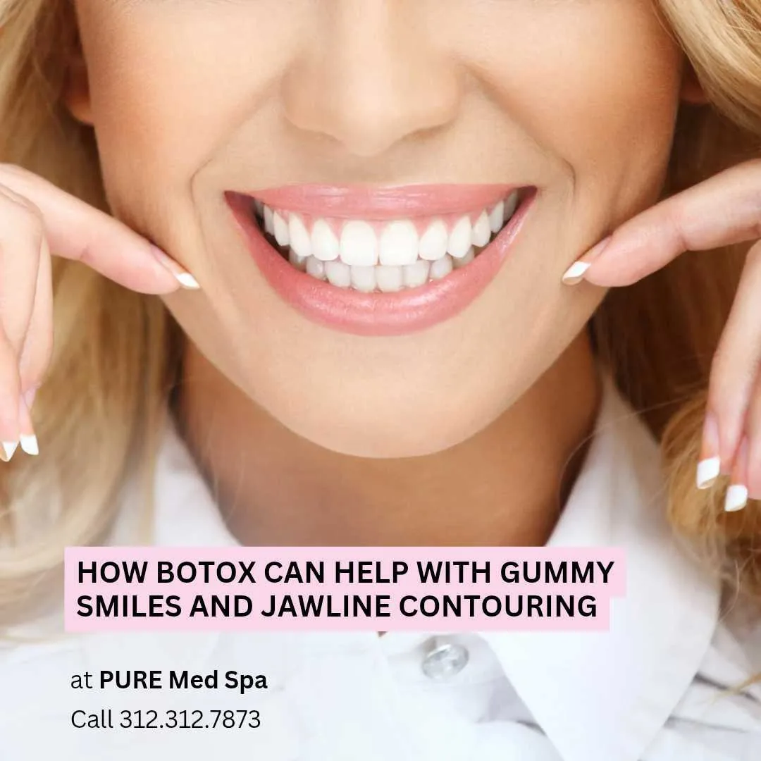 How Botox Can Help With Gummy Smiles and Jawline Contouring How Botox Can Help With Gummy Smiles and Jawline Contouring