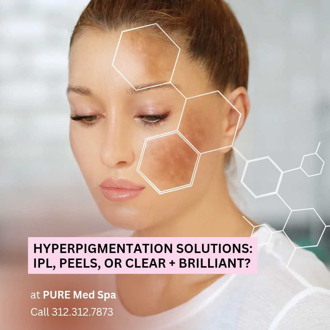 Hyperpigmentation Solutions Hyperpigmentation Solutions