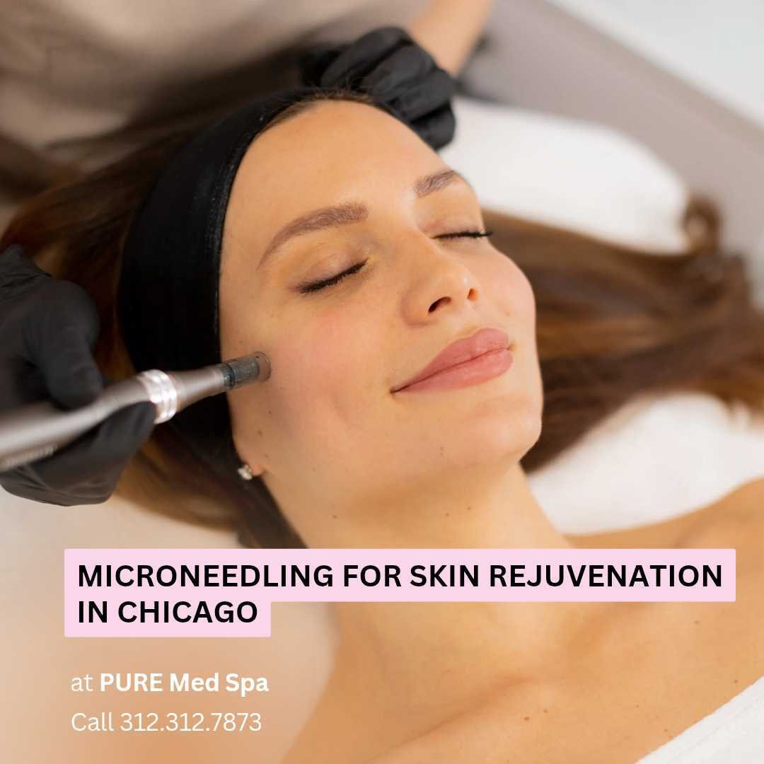 Microneedling for Skin Rejuvenation at Pure Chicago Microneedling for Skin Rejuvenation at Pure Chicago