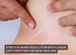 Stretch Mark Reduction with Laser