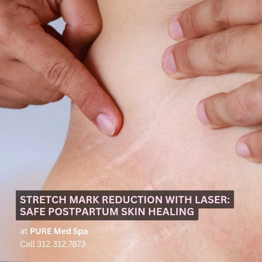 Stretch Mark Reduction with Laser Stretch Mark Reduction with Laser