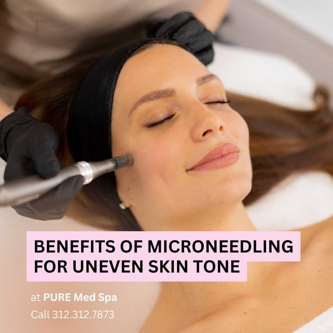 Benefits of Microneedling for Uneven Skin Tone Benefits of Microneedling for Uneven Skin Tone