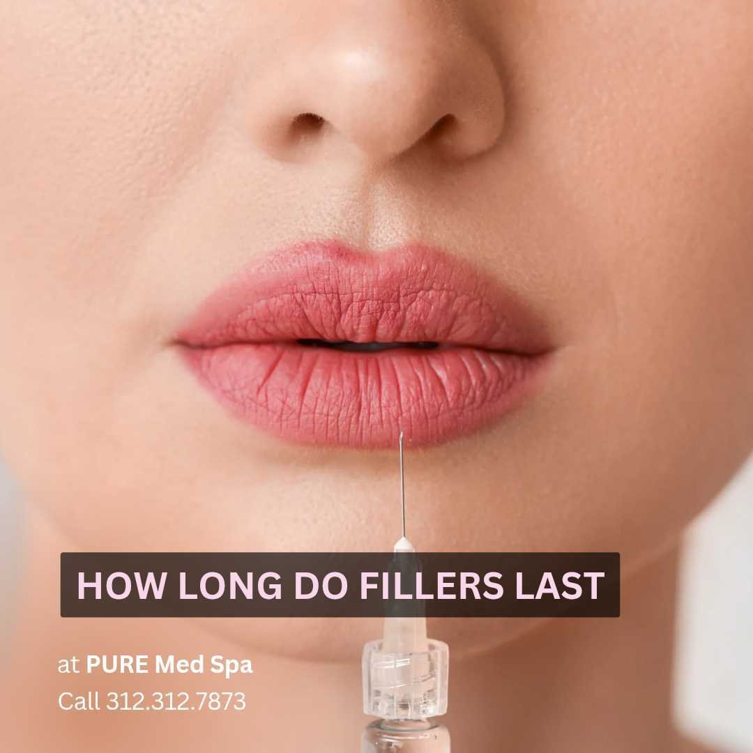 How Long Do Fillers Last How Long Do Fillers Last