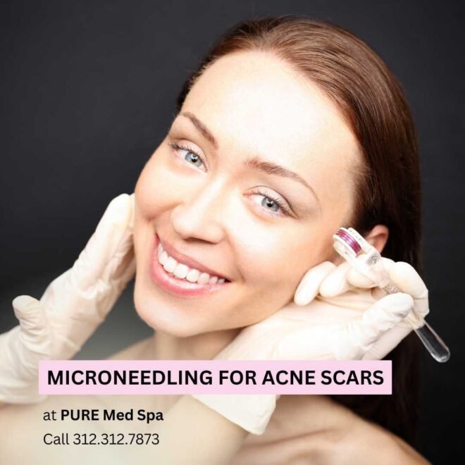 Microneedling for Acne Scars Microneedling for Acne Scars