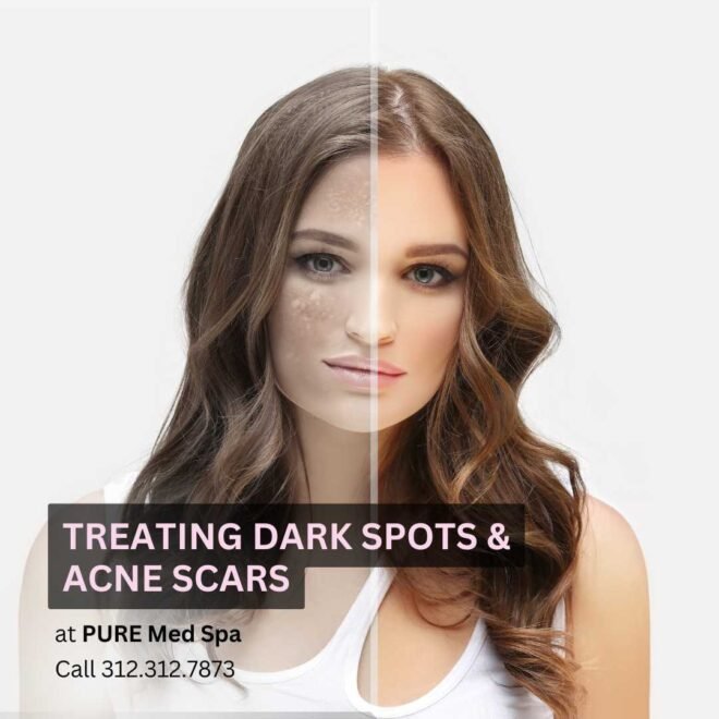 Treating Dark Spots & Acne Scars