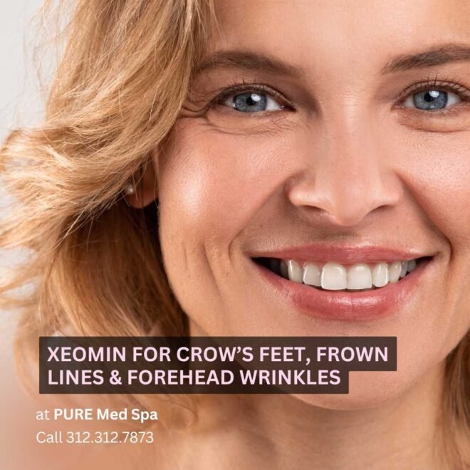Xeomin for Crow’s Feet
