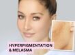 Hyperpigmentation & Melasma