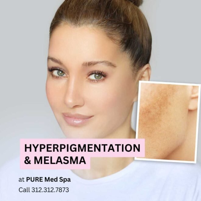 Hyperpigmentation & Melasma
