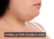 Kybella for Double Chin