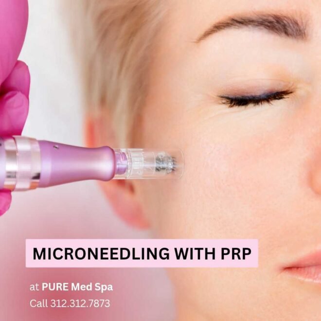 Microneedling with PRP Microneedling with PRP