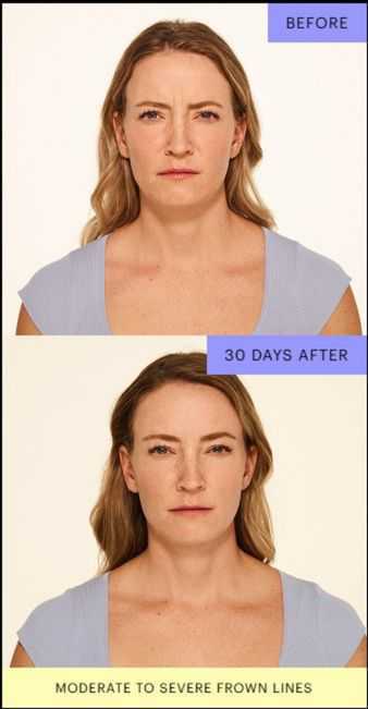 Smooth, Slim, Confident_ The Best Botox Near You.pdf_20250707_132241_0000