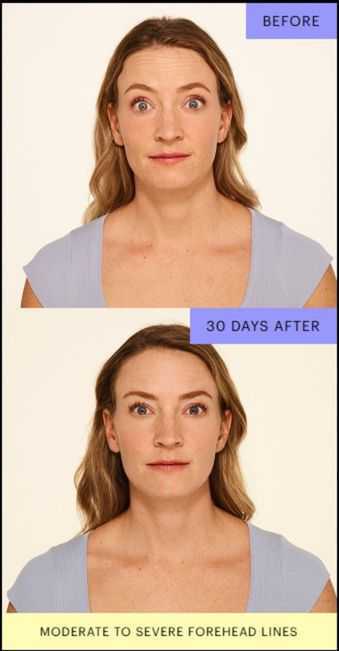 Smooth, Slim, Confident_ The Best Botox Near You.pdf_20250707_132305_0000