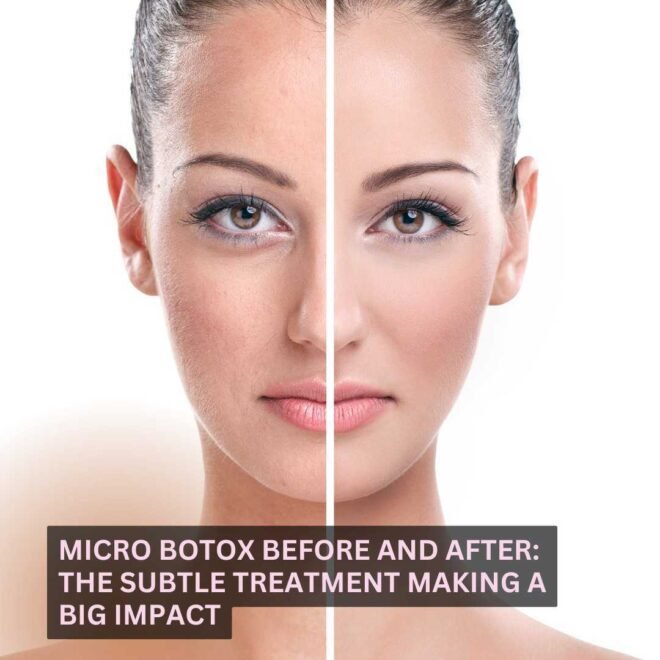 Micro Botox Before and After. Micro Botox Before and After.
