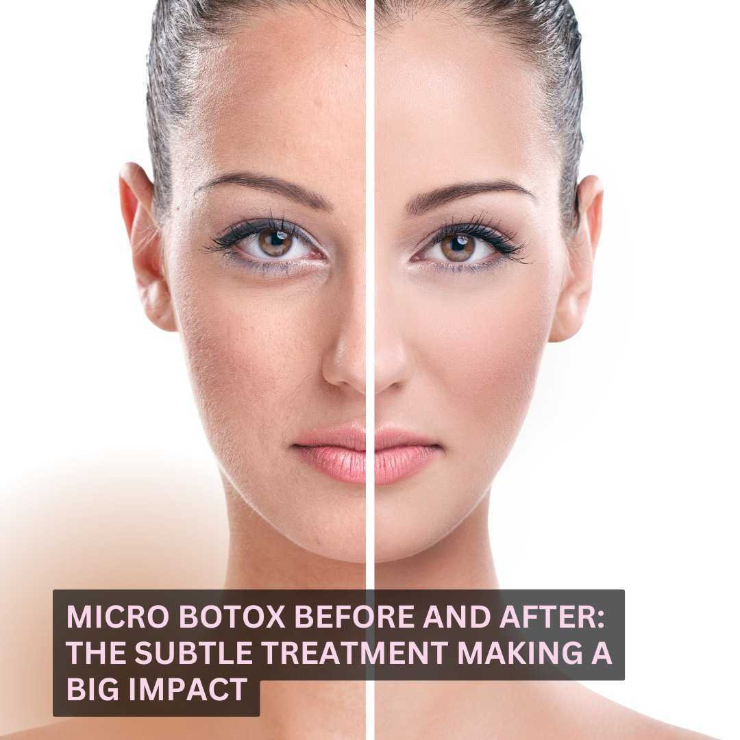 Micro Botox Before and After. Micro Botox Before and After.