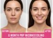 6 Month PRP Microneedling Transformation Results