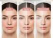 Chemical peels for acne, aging, and pigmentation