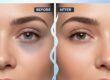 Do Under Eye Fillers Help Dark Circles or Puffiness