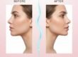 How Jawline Fillers Define Your Face Naturally