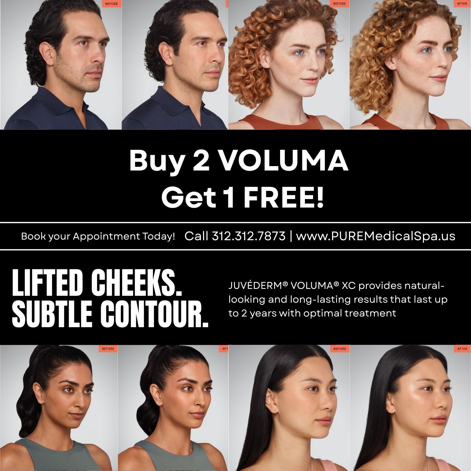 Buy 2 Voluma Get 1 Free offer with cheek filler before and after results at PURE Medical Spa Chicago