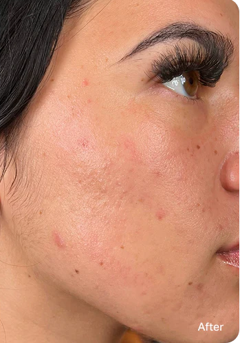 After HydraFacial treatment showing clearer skin at PURE Medical Spa Chicago