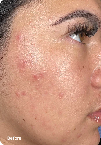 Before HydraFacial treatment at PURE Medical Spa Chicago