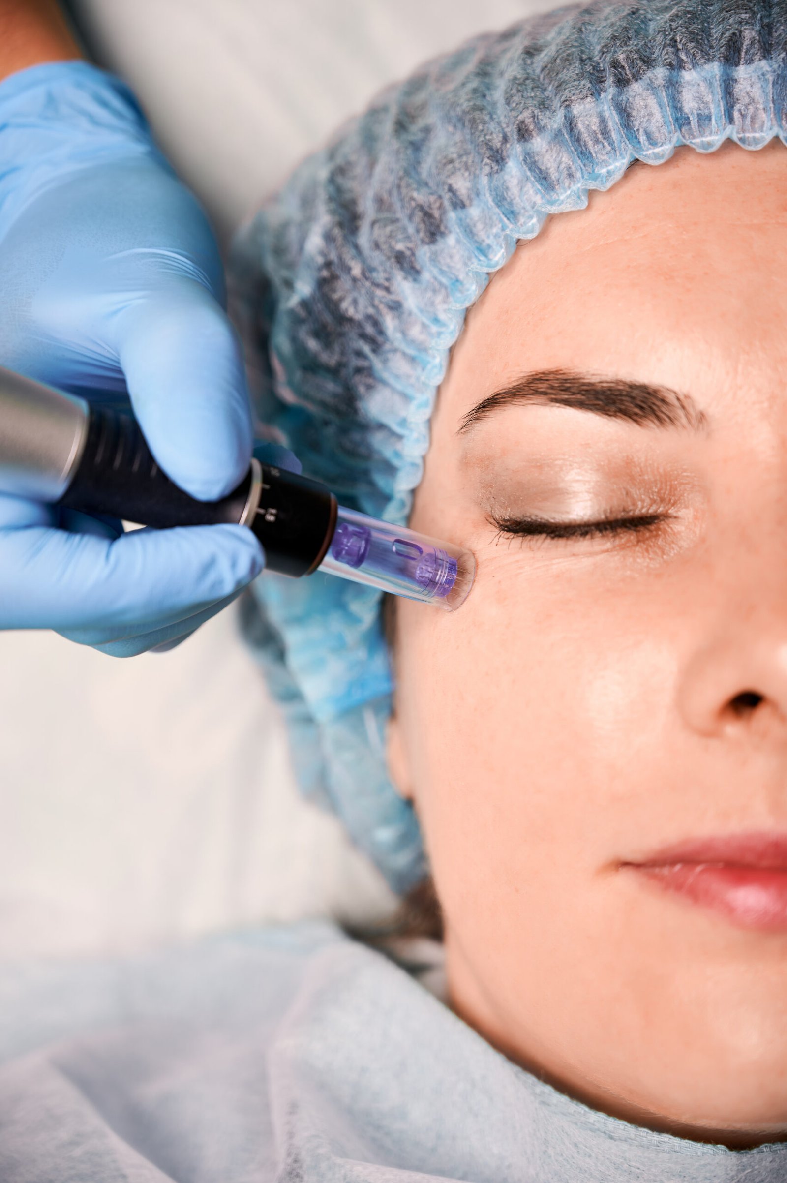 Microneedling treatment at PURE Medical Spa Chicago