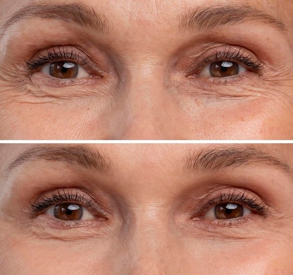 Botox results at PURE Medical Spa, Gold Coast Chicago