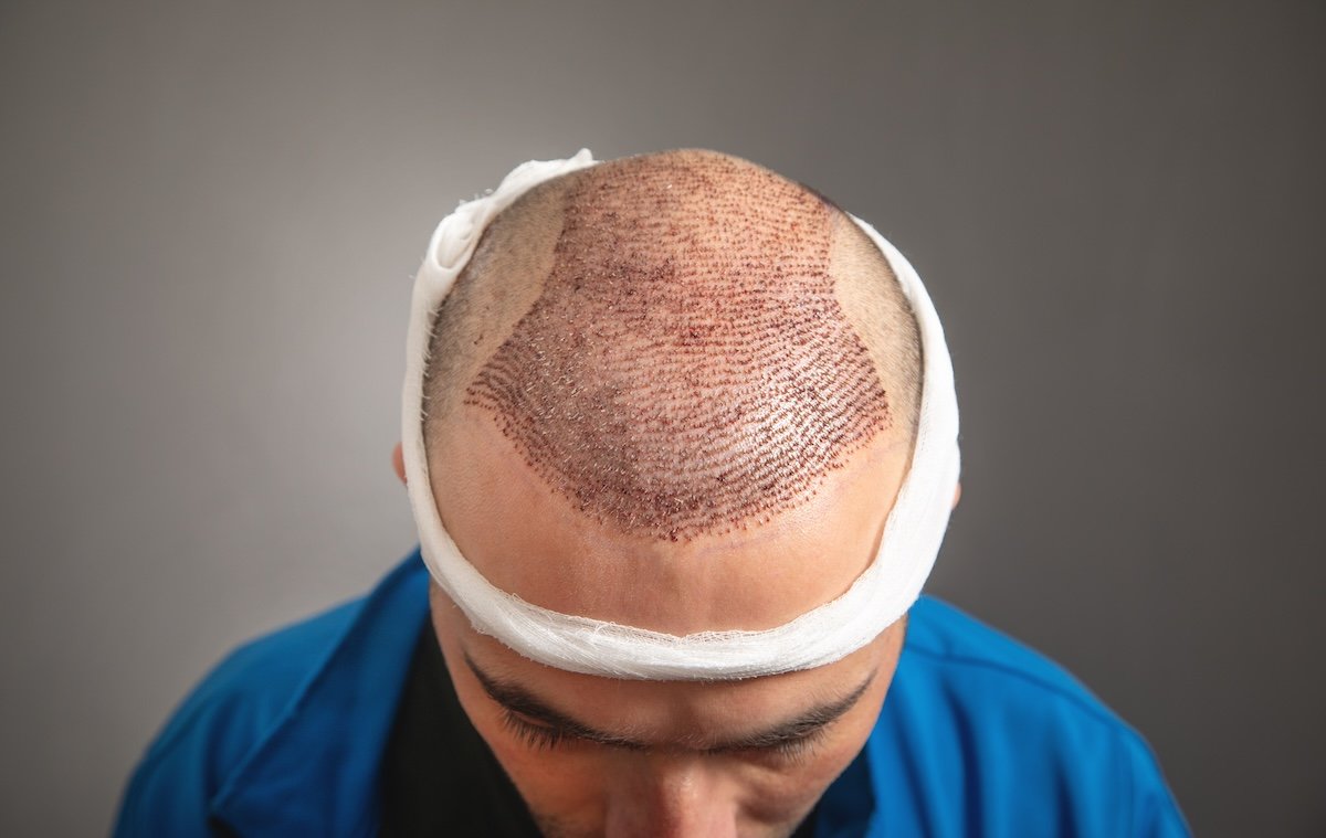 Hair restoration progress documented with standardized photography in Chicago