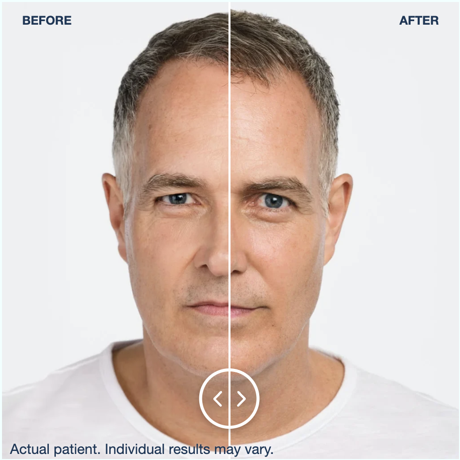 Radiesse male lower face before and after results, clinical photo courtesy of Merz Aesthetics