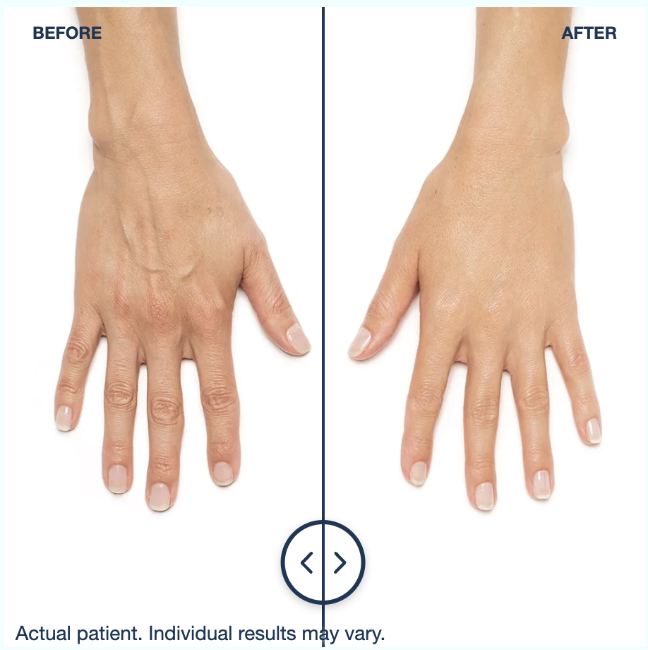 Radiesse hand rejuvenation before and after results, clinical photo courtesy of Merz Aesthetics