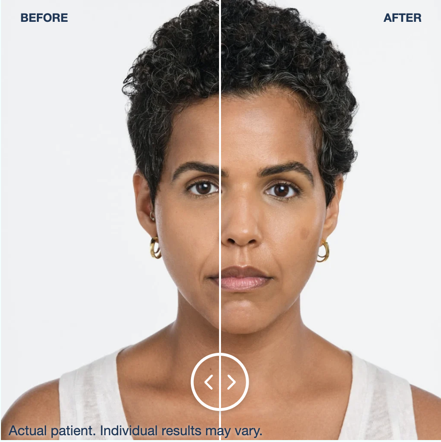 Radiesse midface and cheek volume before and after results, clinical photo courtesy of Merz Aesthetics