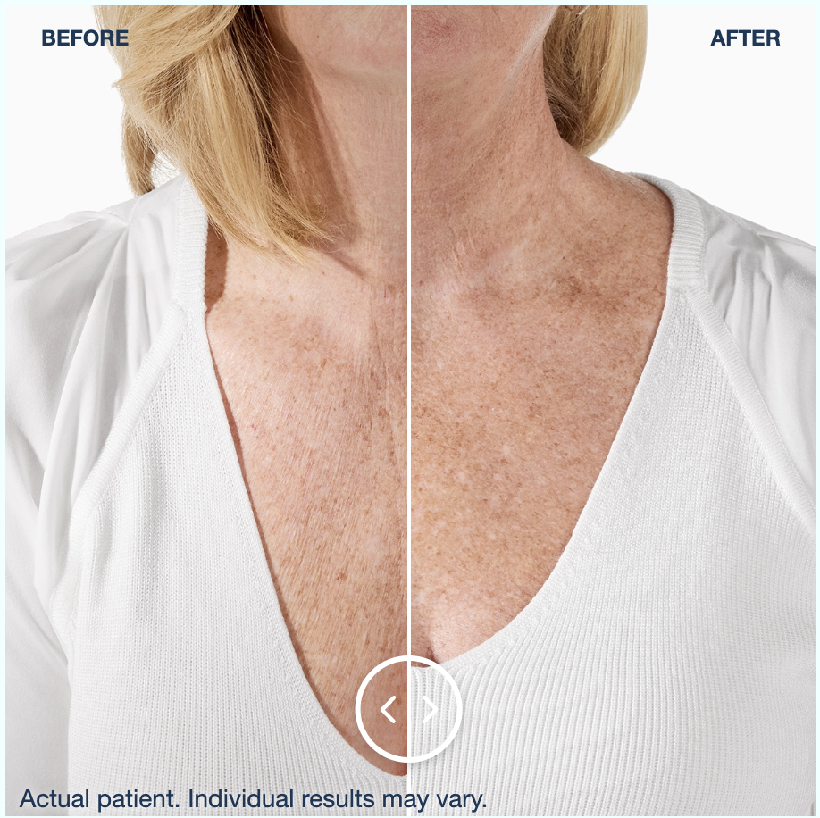 Hyperdiluted Radiesse neck and decolletage before and after results, clinical photo courtesy of Merz Aesthetics