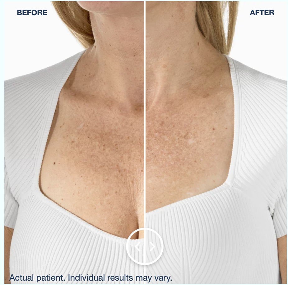 Radiesse decolletage skin quality before and after results, clinical photo courtesy of Merz Aesthetics