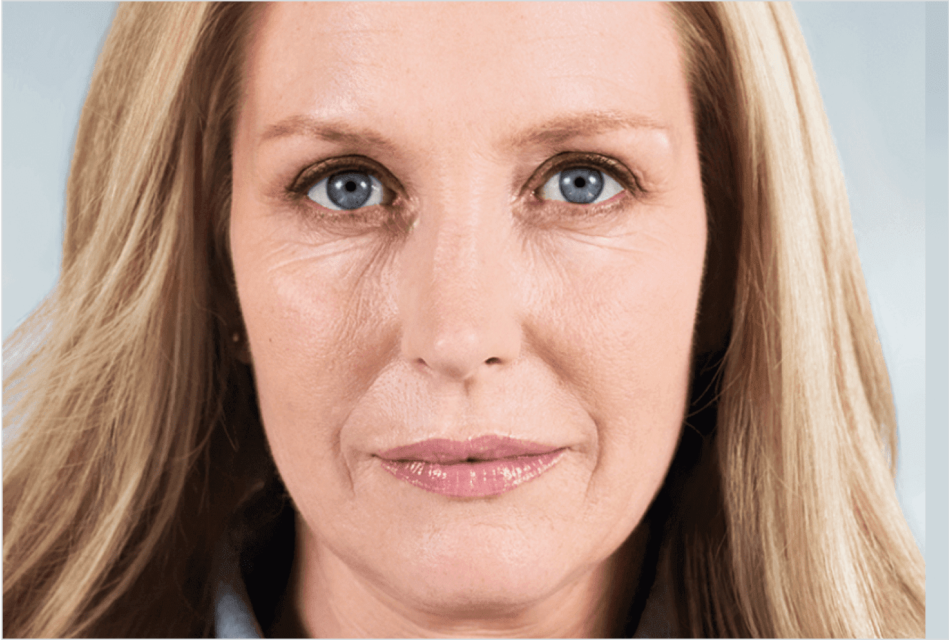 Before Sculptra treatment at PURE Medical Spa Chicago
