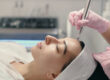 Microneedling
