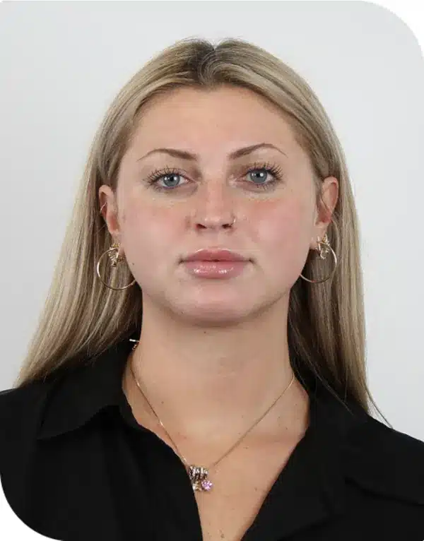 Woman one day after microneedling with ariessence pure PDGF+ applied, showing calm, even skin