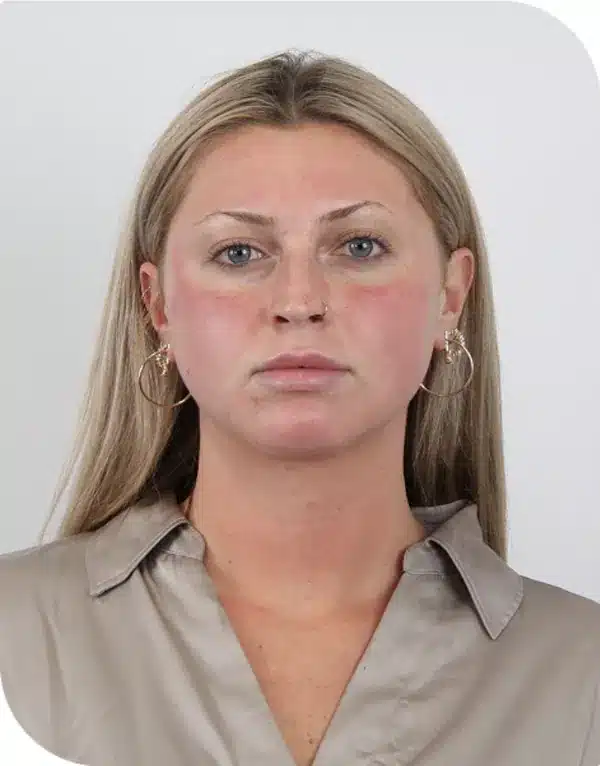 3 hours after microneedling with ariessence, redness much reduced