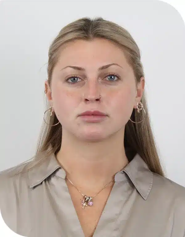 Before microneedling with ariessence, baseline photo