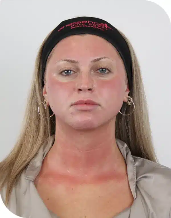 Immediately after microneedling with ariessence applied, skin red