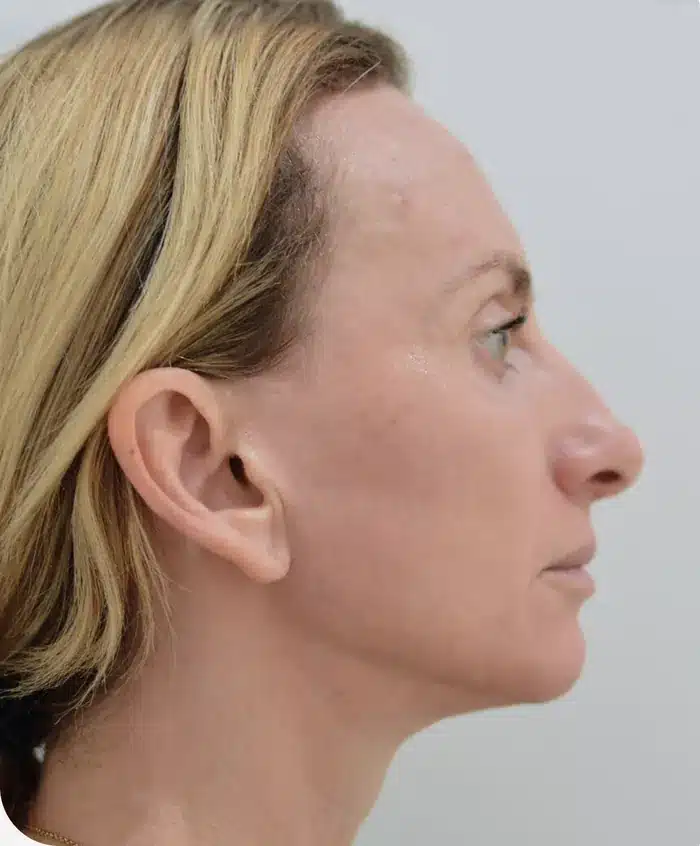 Front view 1 day after skin procedure with ariessence, recovered skin