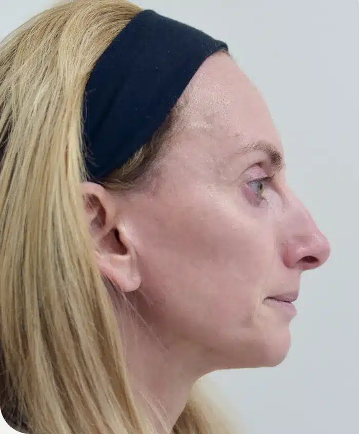 Front view before skin procedure with ariessence, baseline