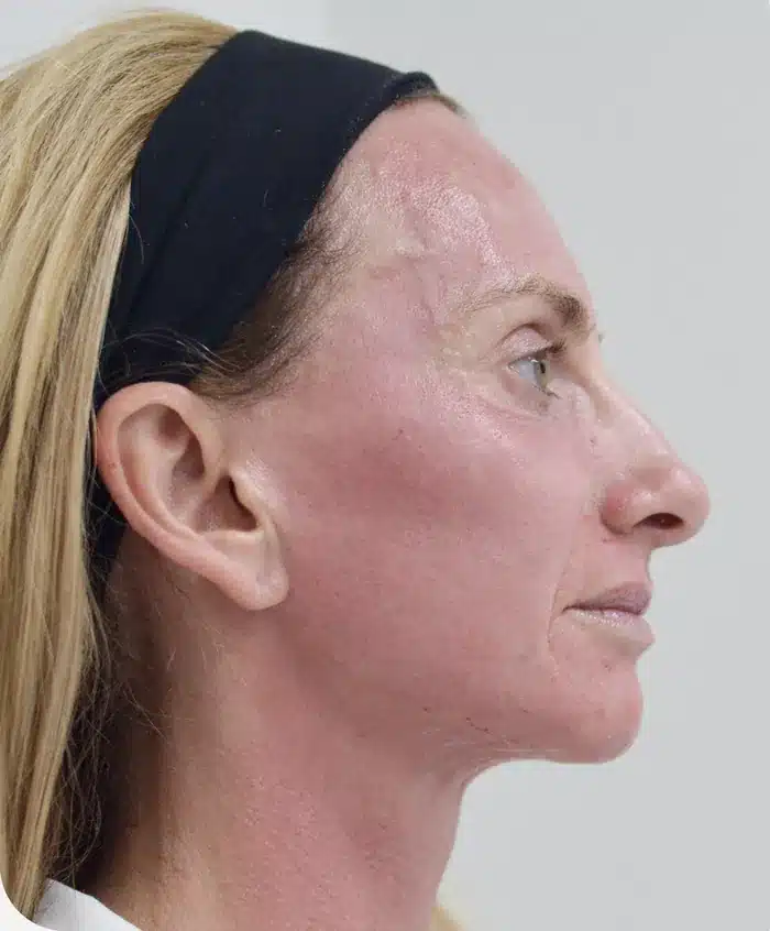 Front view immediately after skin procedure with ariessence applied