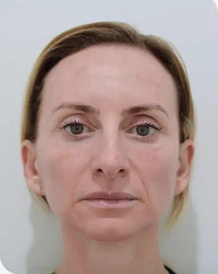 Profile view 1 day after skin procedure with ariessence, recovered skin