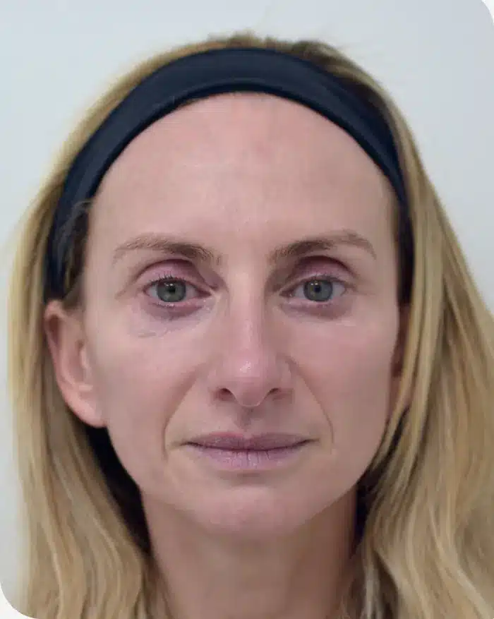 Profile view before skin procedure with ariessence, baseline