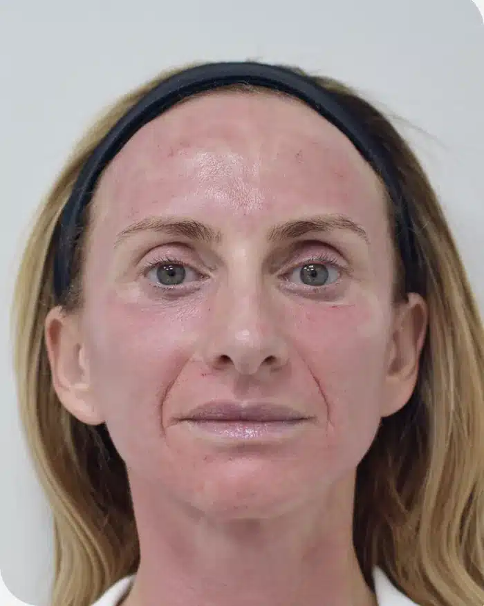 Profile view immediately after skin procedure with ariessence applied