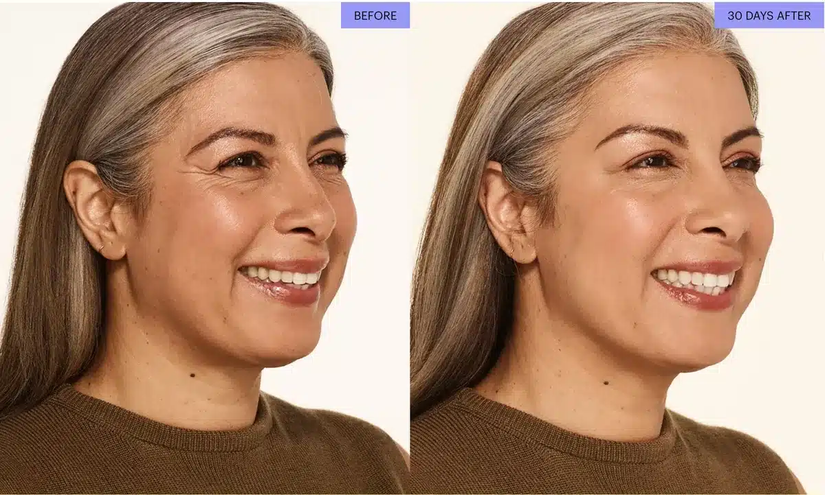 Botox before and after for crow's feet, woman age 46, 30 days after treatment