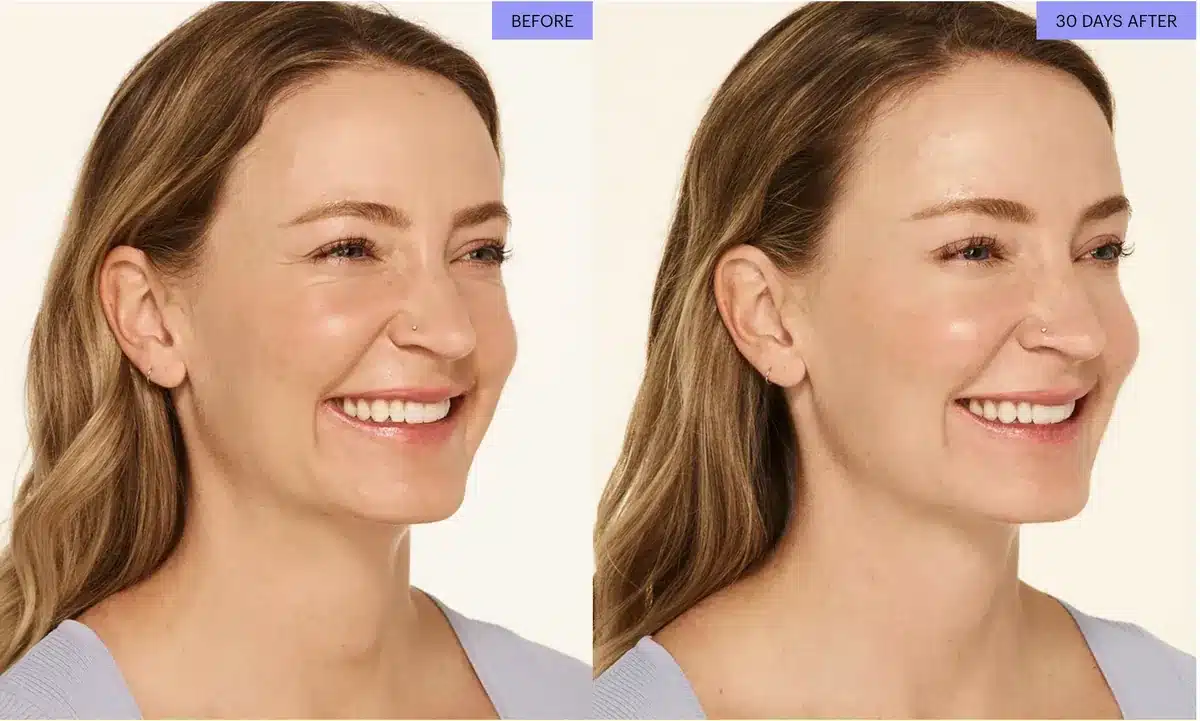 Botox before and after for crow's feet, woman age 32, 30 days after treatment