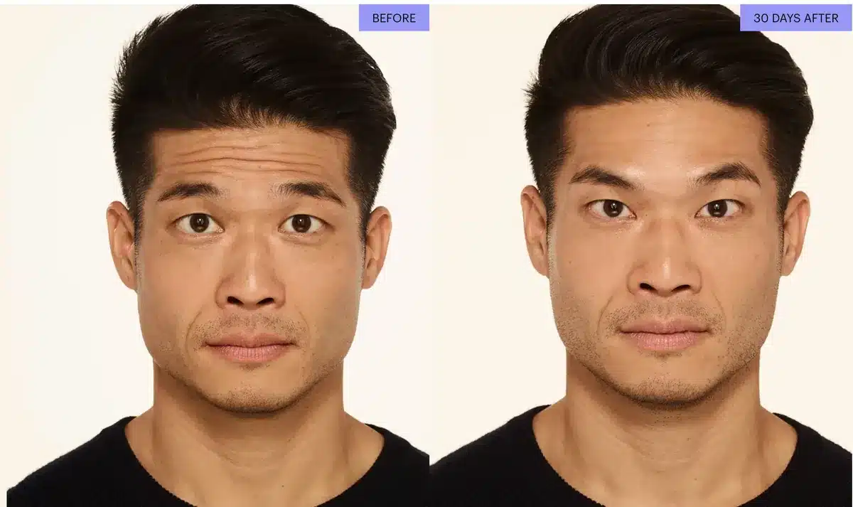 Botox before and after for forehead lines, man age 38, 30 days after treatment