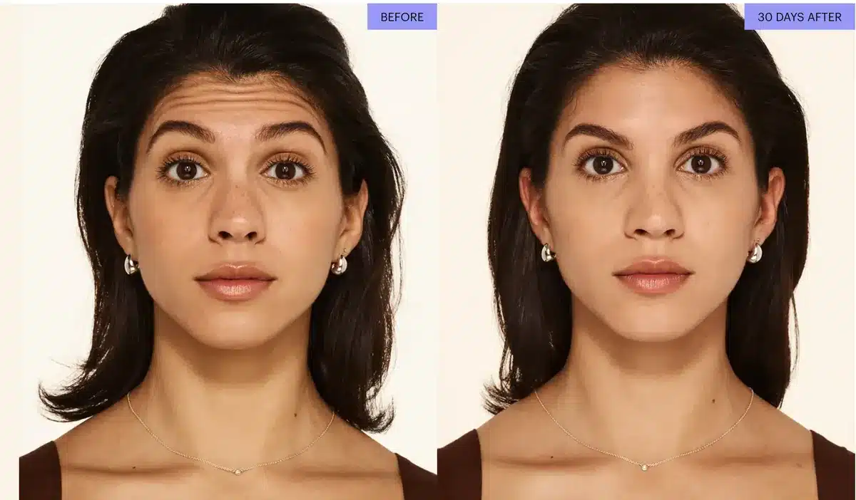 Botox before and after for forehead lines, woman age 29, 30 days after treatment