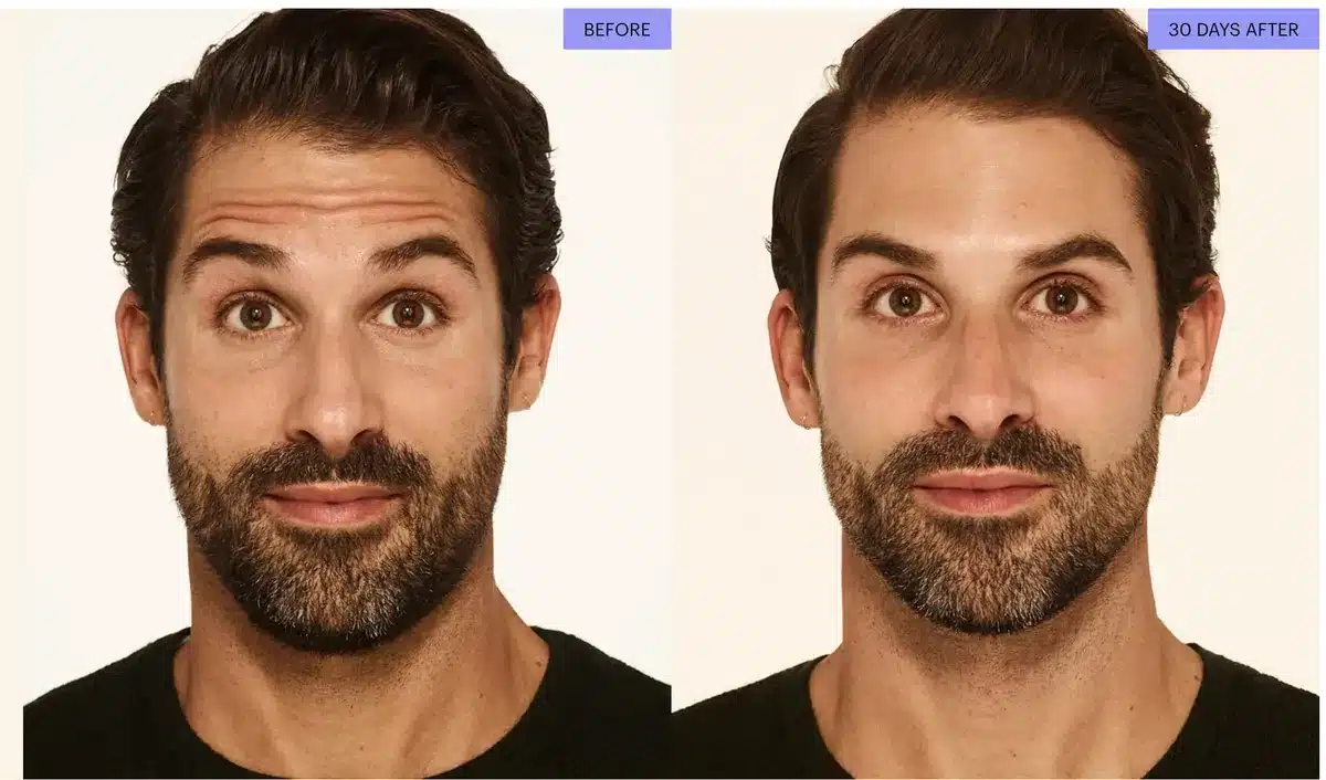 Botox before and after for forehead lines, man age 35, 30 days after treatment